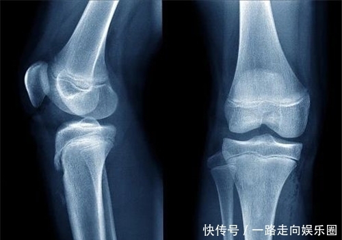 极端|生于侏儒,死于巨人,他是世界上唯一一个患有两种极端病症的人