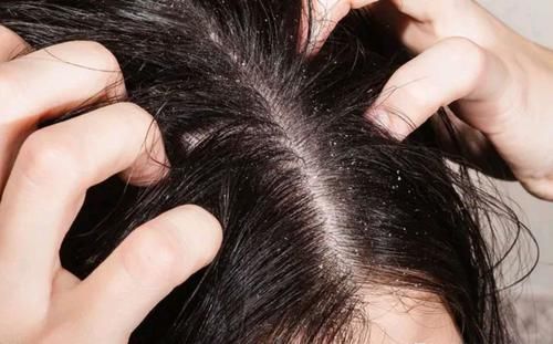 营养物质|头皮上抠出“白泥”，不仅仅是没洗头那么简单，这些原因也别忽视