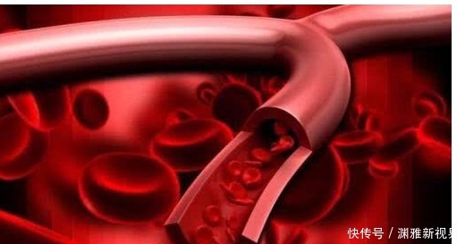 心脑血管疾病|血液粘稠的“稀释药”找到了,每天吃一点,净化血液,血栓不来扰