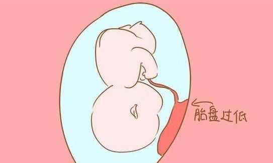 胎儿|若你怀孕时,“胎盘低”的原因是什么?对胎儿有什么影响吗?