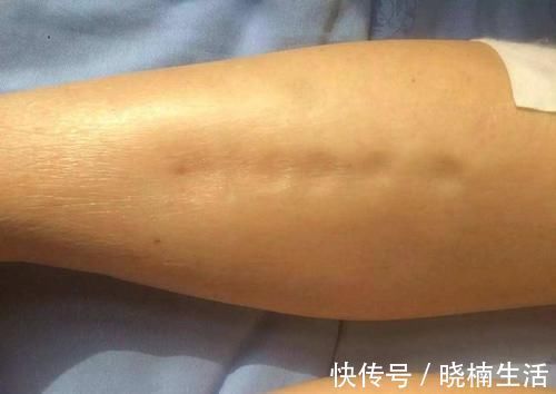 痛风|厨房这3种调味料,是尿酸加速器,吃多一点痛风发作更痛一分