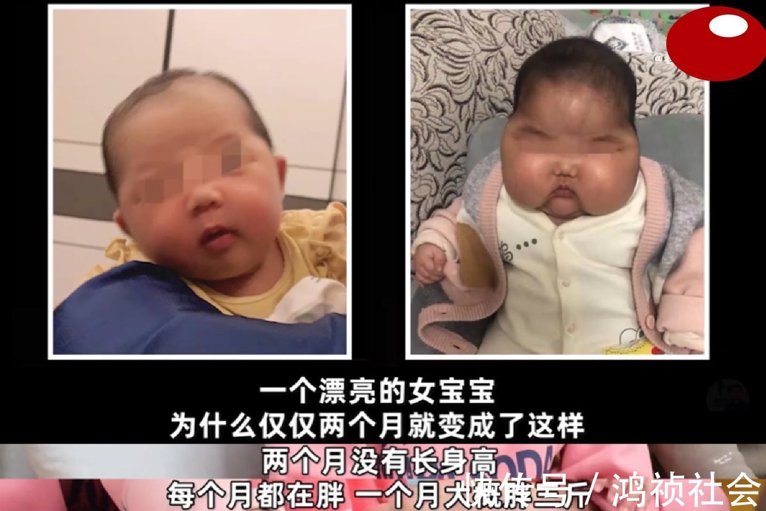 氯倍他索丙酸酯|“大头娃娃”再现,抑菌霜激素超标,致5个月女婴疯狂长胖长毛