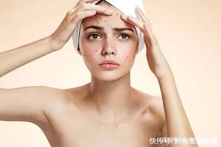 ME小科普:总是长痘痘怎么办?痘痘、闭口、粉刺你能分得清吗?