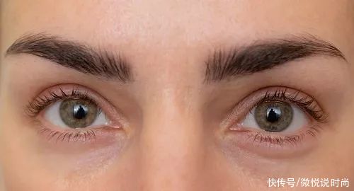 黑眼圈很严重怎么办？怎么拯救特别严重的黑眼圈？