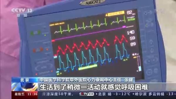 心力衰竭|心衰到底离你有多远？专家：不是老年人“专利”