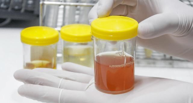 嘴里|尿酸高的人,身体出现3种异常,警惕肾衰竭,3种饮品少往嘴里倒