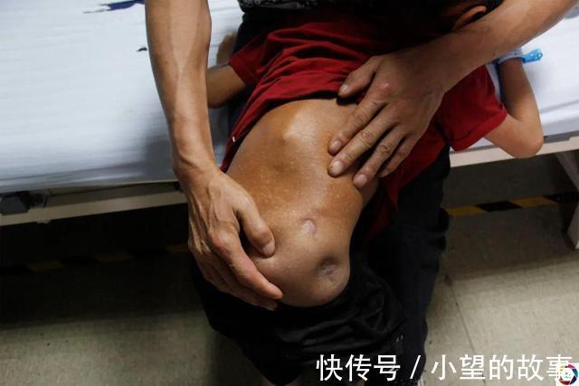 儿子|男童骨折后不敢说导致残疾,妈妈离去,耳聋爸爸苦苦携其求医4年