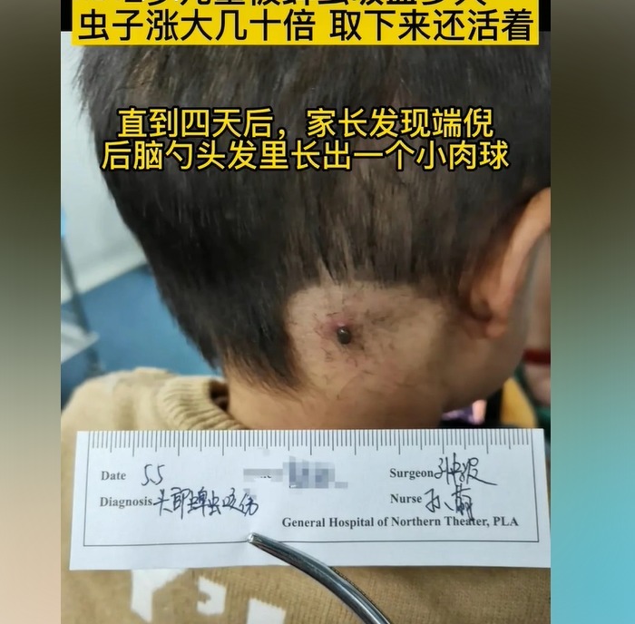 医生|3岁孩子被蜱虫咬,妈妈的“三个果断”救了娃,医生点赞有见识