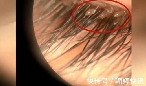 细菌|女儿总爱揉眼睛,妈妈感觉不对带去检查,医生的话让她后怕不已