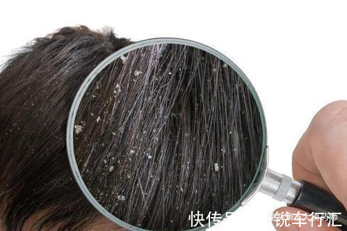 脓包|几天洗一次头最好?头发一湿就用洗发水?几个洗发误区,值得了解