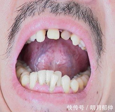 青紫|身体里有肿瘤，舌头上也会有表现！出现3种异象需小心