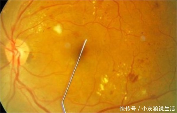 原来眼睛也会得癌症,大多数其实都是你自己“作”出来的