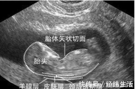 产检|孕期产检不想生个“傻孩子”,这三项产检必须按时做,不能忽视