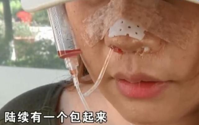 女子整容花费6万元,脸上天天挂着注射器,医院赔你13000