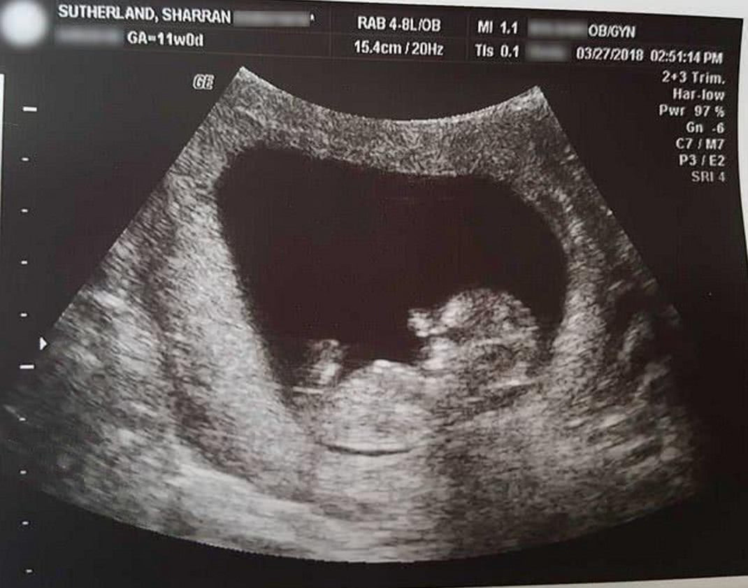 死亡|孩子在母亲腹中死亡,母亲不希望孩子变医疗垃圾,带回家种花盆里