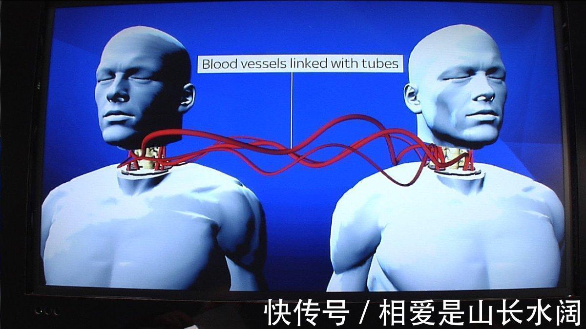 活人|世界首个活人换头手术，俄罗斯小伙自愿成为实验者，结果怎么样了