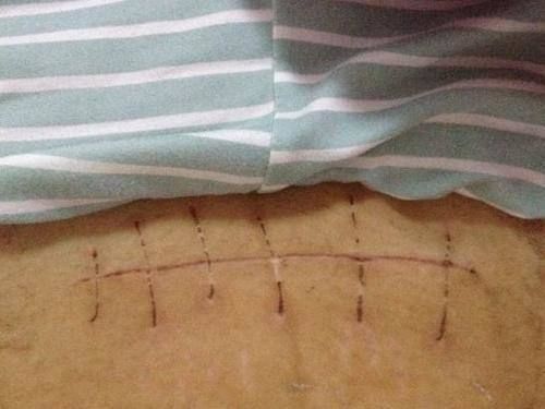 95后|“假如能重来我要选顺产”,95后妈妈的哭诉,道出剖腹产背后辛酸