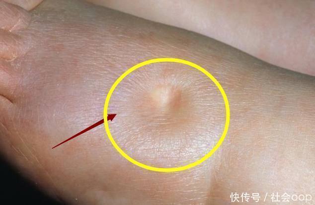 肺栓塞|体内有没有血栓,看看你的手和脚就知道