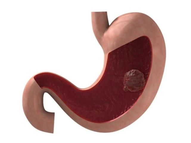 食物|65岁院士研究胃病30年,提醒:三物比辣椒伤胃,劝你少吃