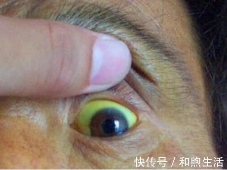 症状|医生提示:身体出现6个症状,十有八九是肝硬化,占一个也要CT