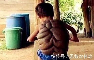龟壳|8岁男孩背上长出龟壳,好像人形乌龟,医生救治后大开眼界