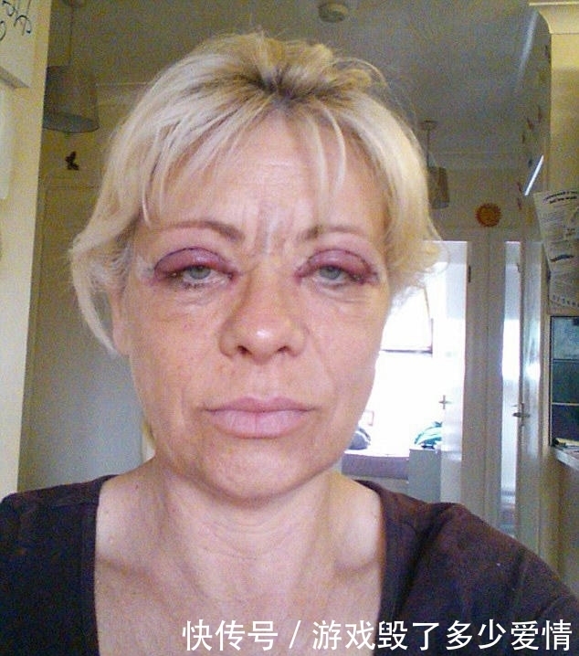 54岁女子贪图便宜,花费2万元在黑市整容,整容后年轻了20岁