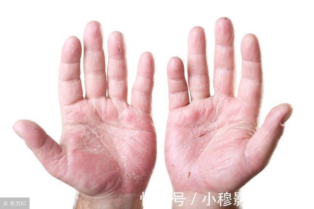 掌心|肝癌多是“拖”出来的,如果双脚有4种迹象,趁早就医,能保命!