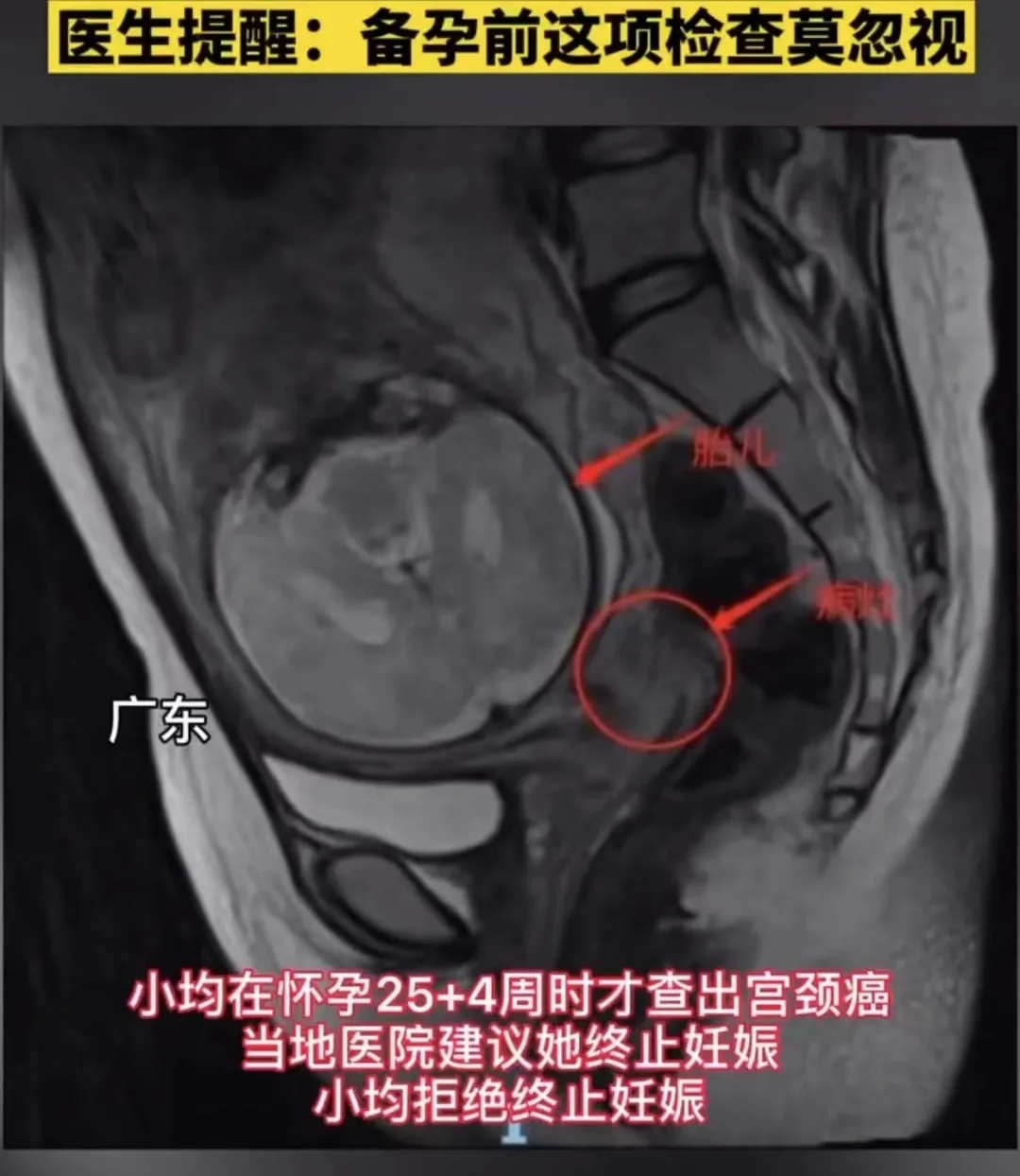 妊娠期|孕25周查出宫颈癌,保命还是保胎?其实这事能提前预防