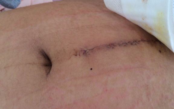 麻醉|剖腹产到底会对女性产生哪些“副作用”大夫说出了实情,别大意