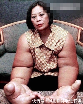 脂肪|女子手臂比大腿还粗,手臂上的脂肪切除掉还是会长出来