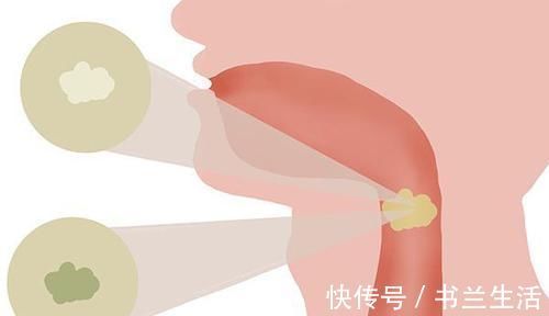 痰液|肺癌引起的咳嗽，与普通咳嗽有啥不同呼吸科医生，教你正确分辨