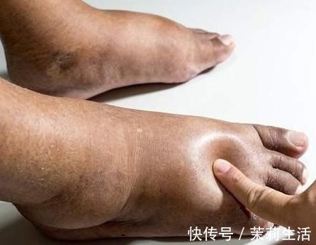 病理性|老年人总是容易脚浮肿,一定病重的征兆?真相来了