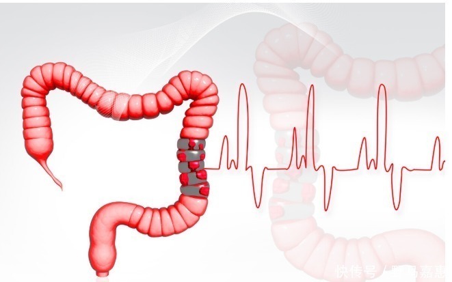 分期|大肠癌早、中、晚期是如何划分的?关键是根据这个信息
