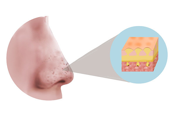 鼻子两侧的鼻翼部位,黑头总是很顽固,教你不用暴力也可轻松去除