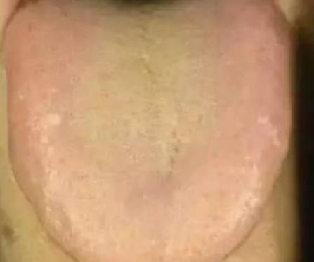 血热|血热还是血寒?看舌象自查!已对比解释
