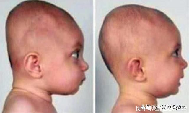 老人|“妈求求你,别给我睡扁头了”扁头有多毁娃?3张对比图告诉你
