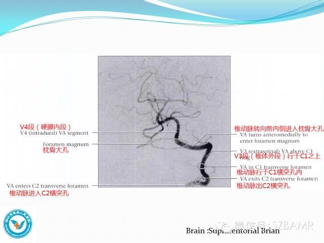 mr|椎-基底动脉系统解剖