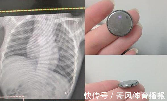 女孩|5岁女孩暴瘦!医生让女孩“摘下项链”,妈妈惊呼:女儿没戴项链