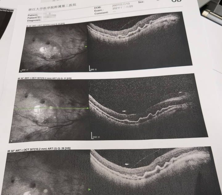 视网膜脱离|守护独眼男孩微光，高难度手术步步惊心