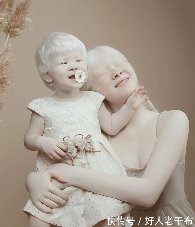 白化病|这对神奇的姐妹俩,曾一出生便浑身“无颜色”,如今粉丝遍布全球