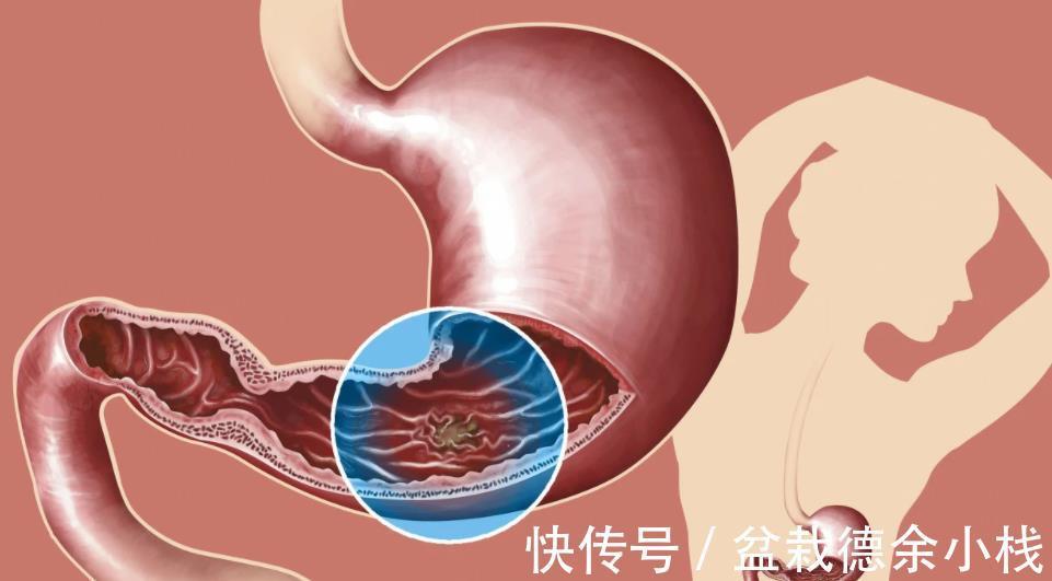甲状腺结节|检查出来的这几种疾病，其实并不需要治疗，别再花冤枉钱了