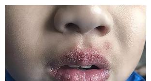 润唇膏|冬季孩子嘴唇起皮、干裂还出血?三招教你正确护理,光喝水没用