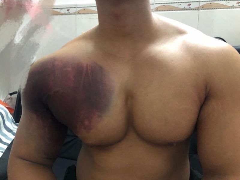 李劼若|健身教练卧举380斤失败胸大肌被生生撕脱