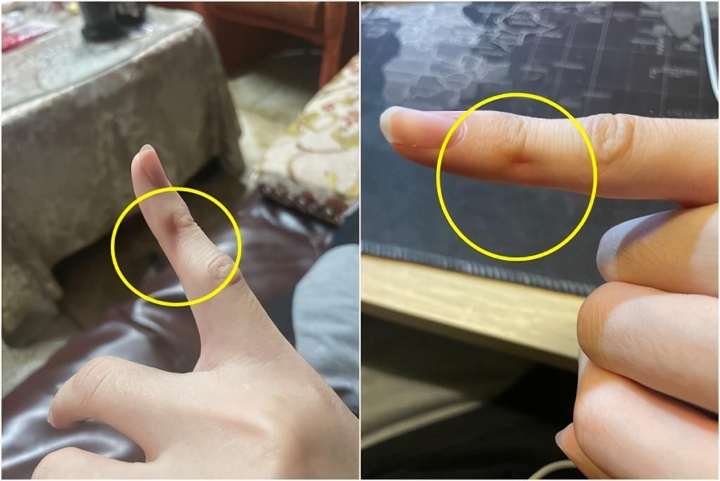 手指关节凹陷图片