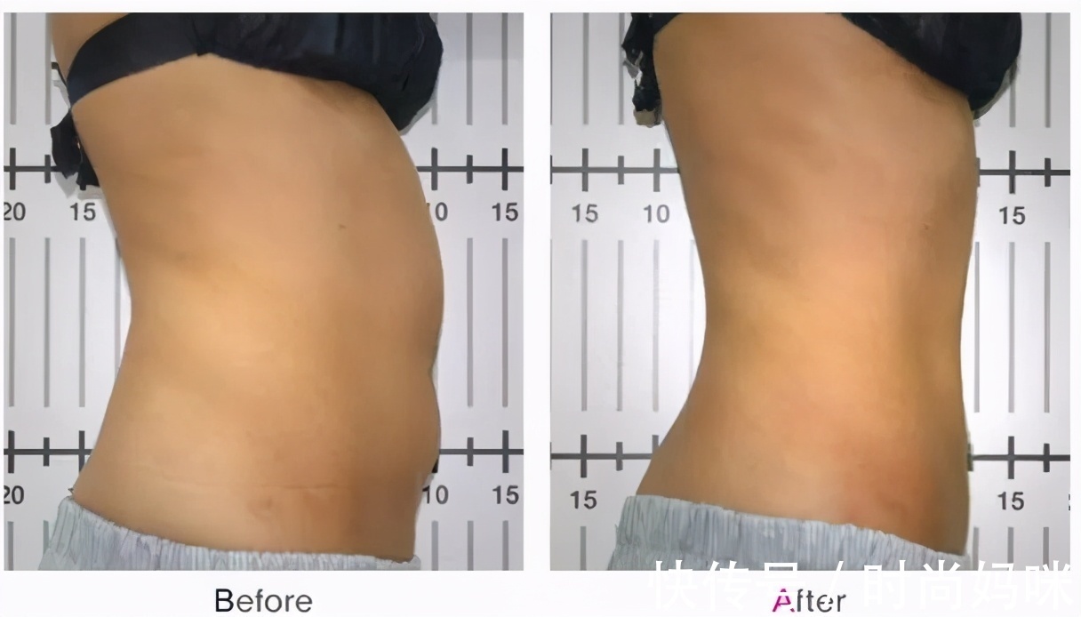 剖腹产|产后肚皮松弛怎样才能收紧?坚持做好这2件事,彻底消灭“游泳圈”