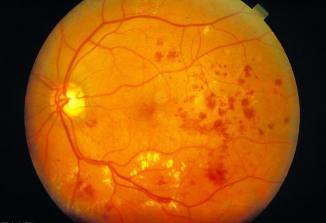 血糖|身体出现3方面问题时,说明糖尿病正在变严重,请尽早控制