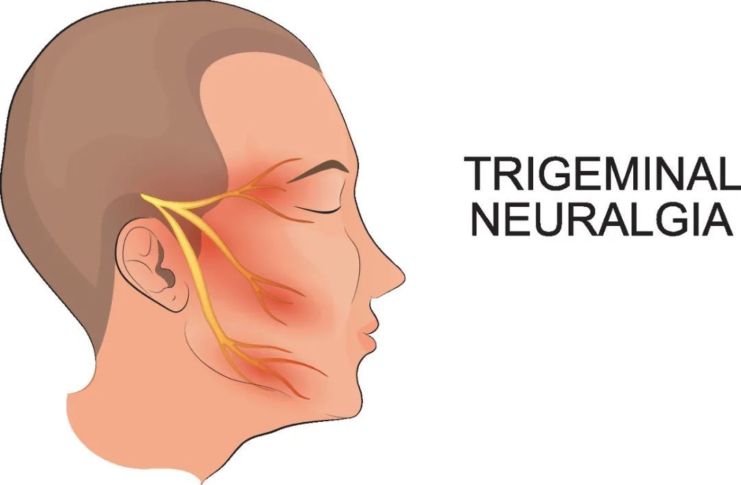 三叉神经|侧脸疼痛也许“坏”不在牙，了解三叉神经痛