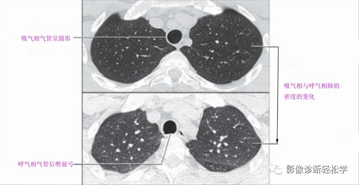 呼气相|肺部HRCT读片基础之四： 气道和肺马赛克灌注