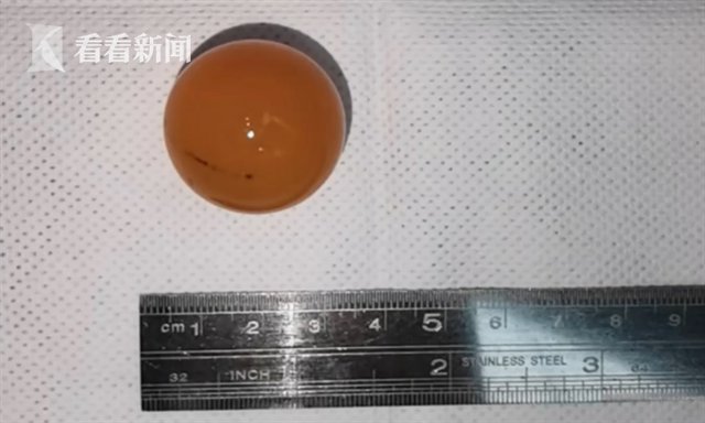 肠梗阻|1岁女童误把网红玩具当糖吞下 医生紧急手术取出