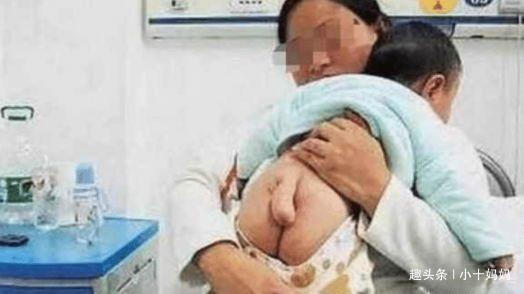 准妈妈|半岁男宝竟长出了“小尾巴”,送医院检查后,医生怒骂宝妈太无知